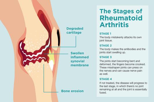 Hereβs why Rheumatoid Arthritis progresses, what to expect, and how to stop it.
